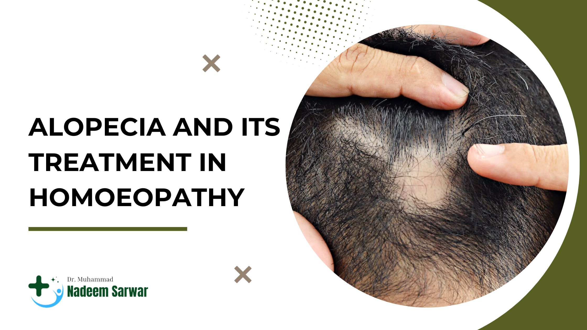 Alopecia and Its Treatment in Homoeopathy