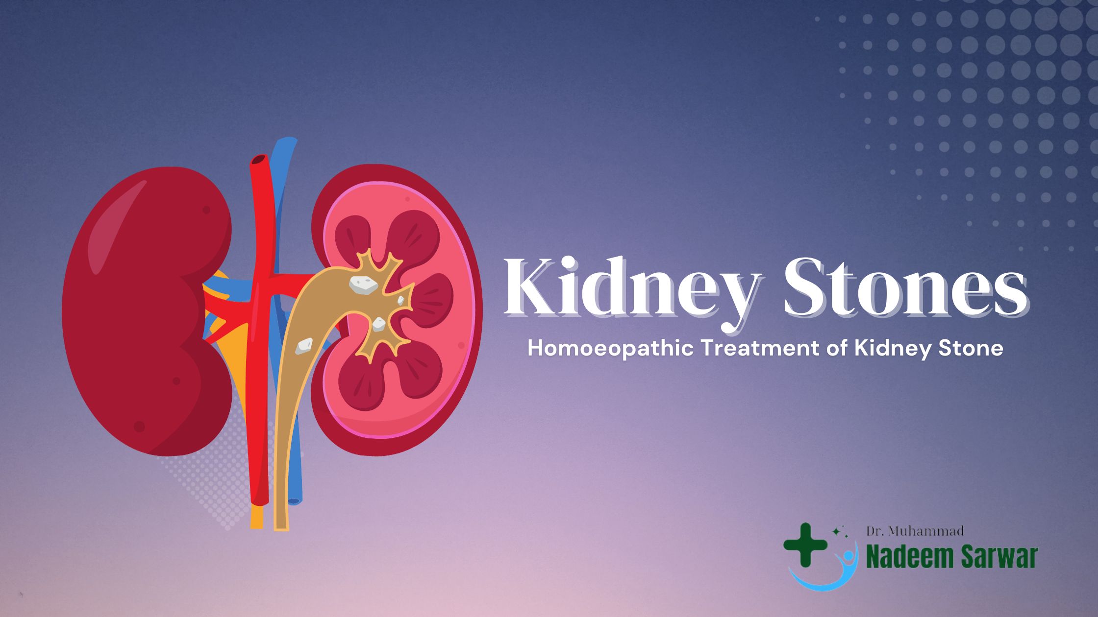 Kidney Stones and Their Homoeopathic Treatment