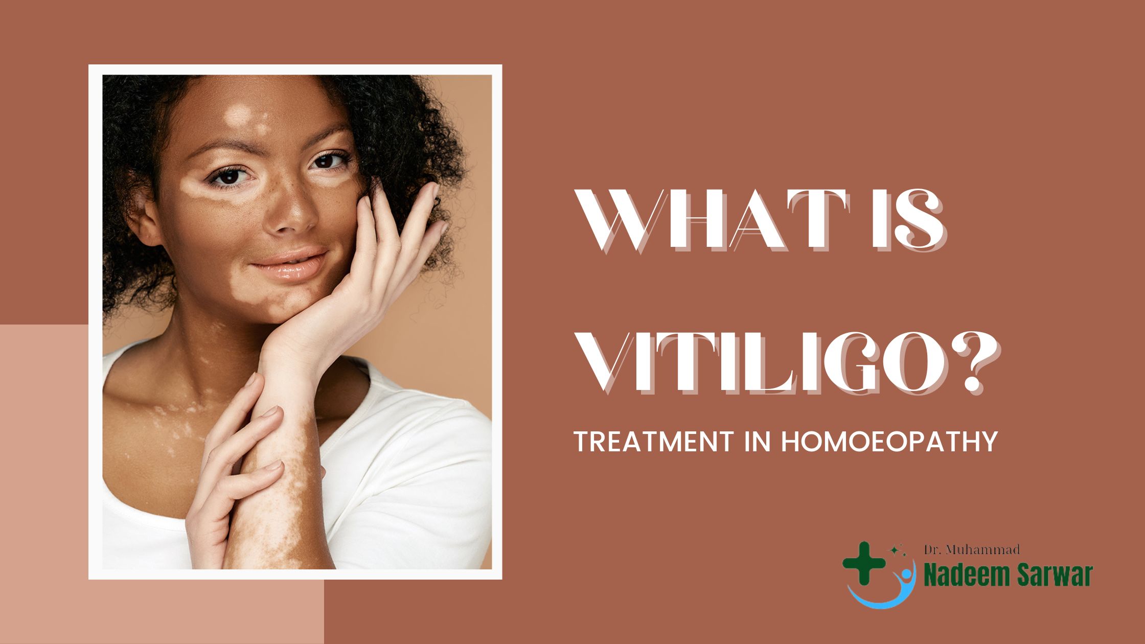 What Is Vitiligo? Treatment in Homoeopathy